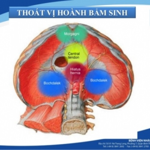 Thoát vị cơ hoành bẩm sinh qua lỗ sau hai bên (Thoát vị Bochdalek)