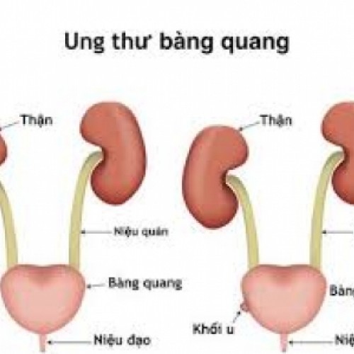 UNG THƯ BÀNG QUANG